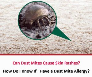 Can Dust Mites Cause Skin Rashes? - All About Dust Mites